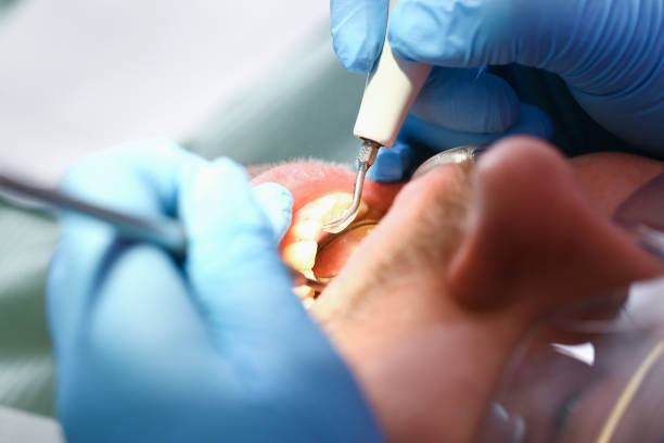 Best Knocked-Out Tooth Emergency  in Bay Harbor Islands, FL