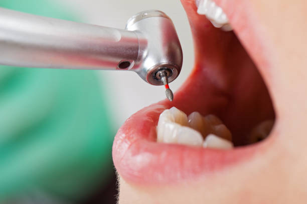 Best Knocked-Out Tooth Emergency  in Bay Harbor Islands, FL